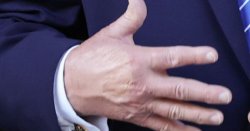 Donald Trump 'paints over black hand' at Zelensky meeting sparks more health fears